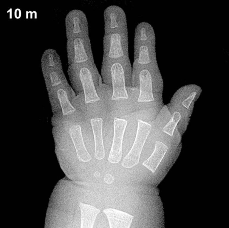 Bone age hand X-ray, boys 10 months