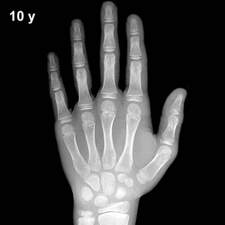 Bone age hand X-ray, boys 10 years