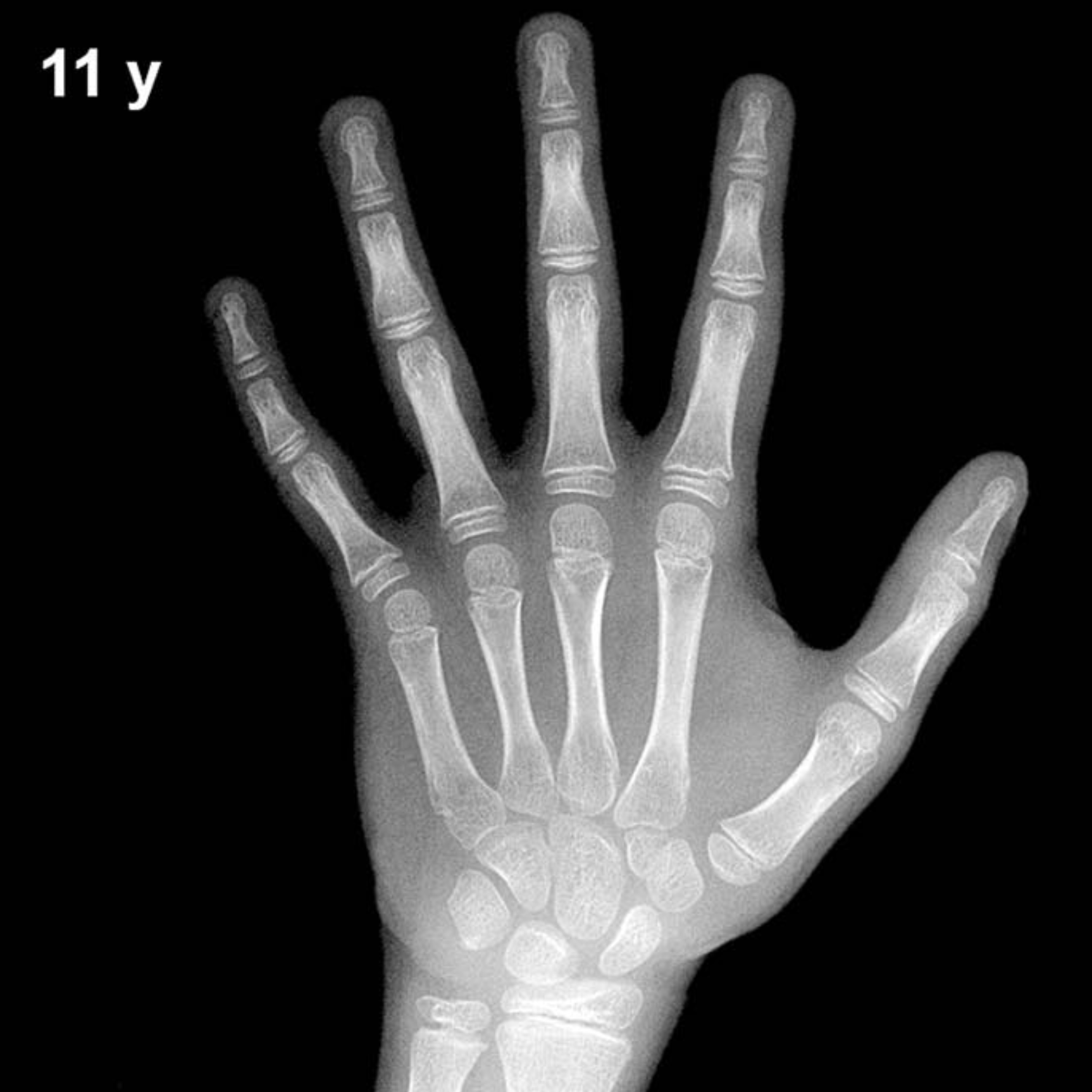 Bone age hand X-ray, boys 11 years