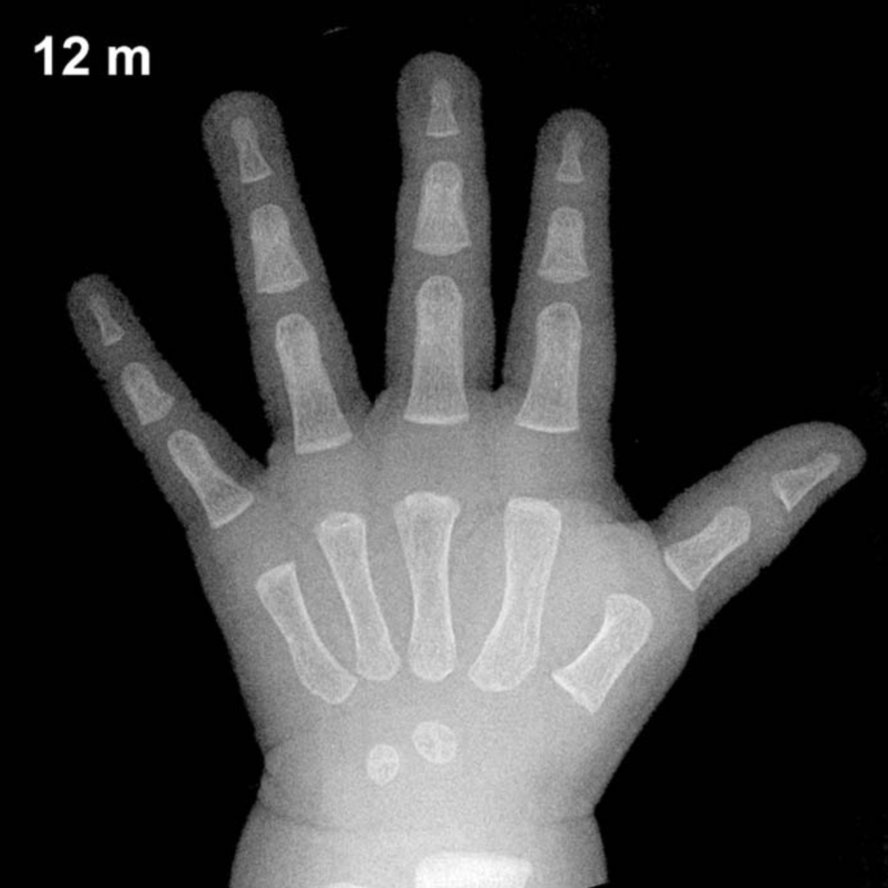 Bone age hand X-ray, boys 12 months