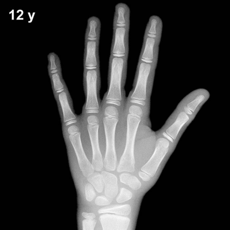 Bone age hand X-ray, boys 12 years