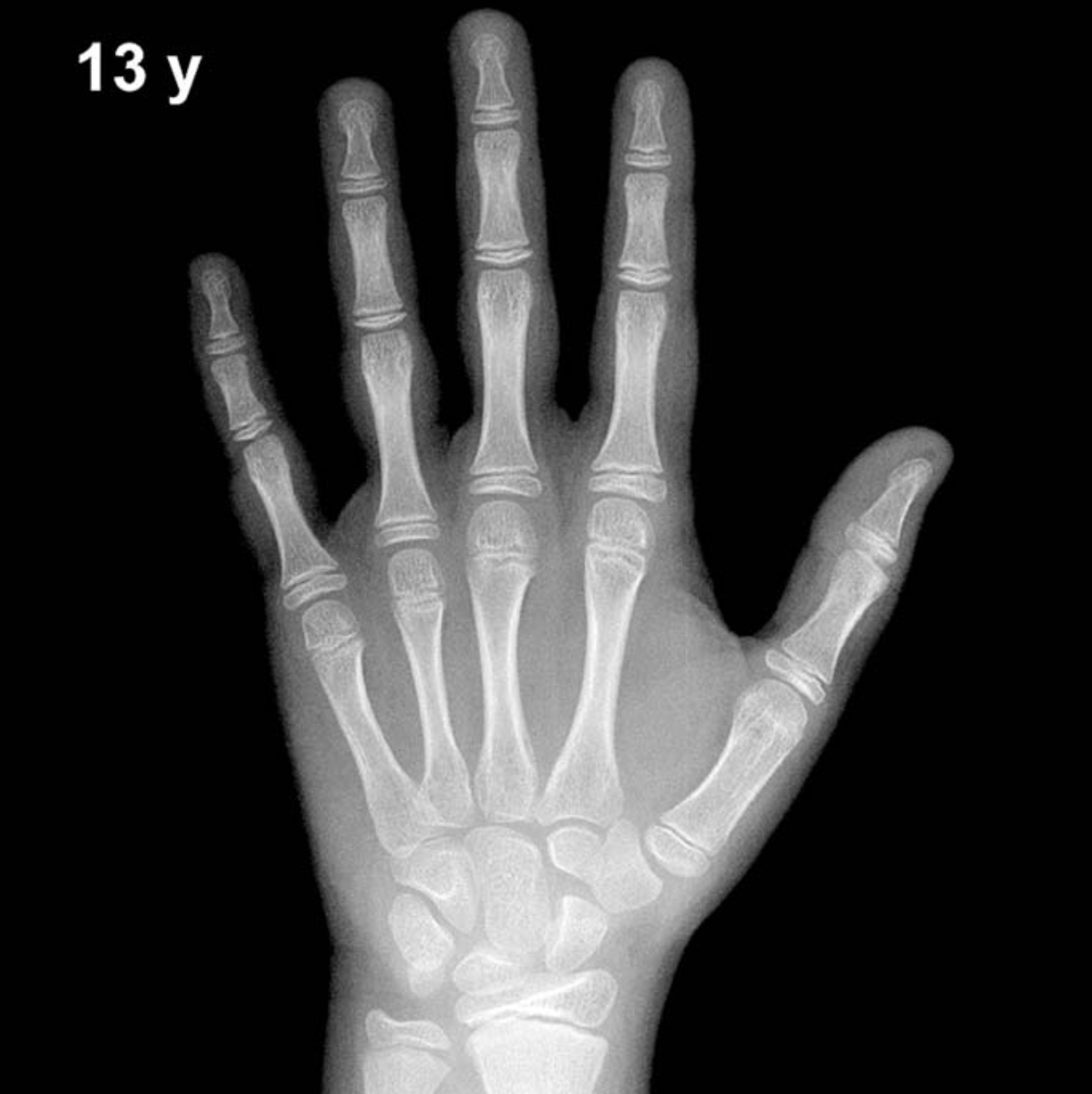 Bone age hand X-ray, boys 13 years
