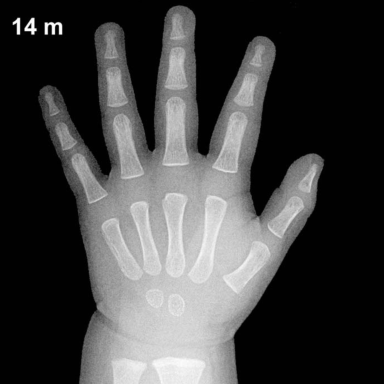 Bone age hand X-ray, boys 14 months