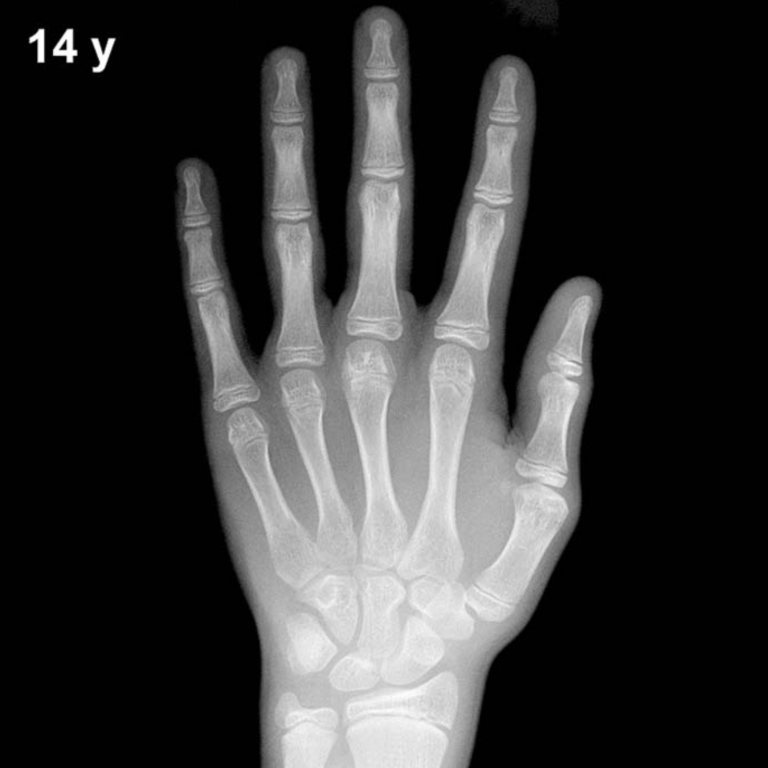 Bone age hand X-ray, boys 14 years