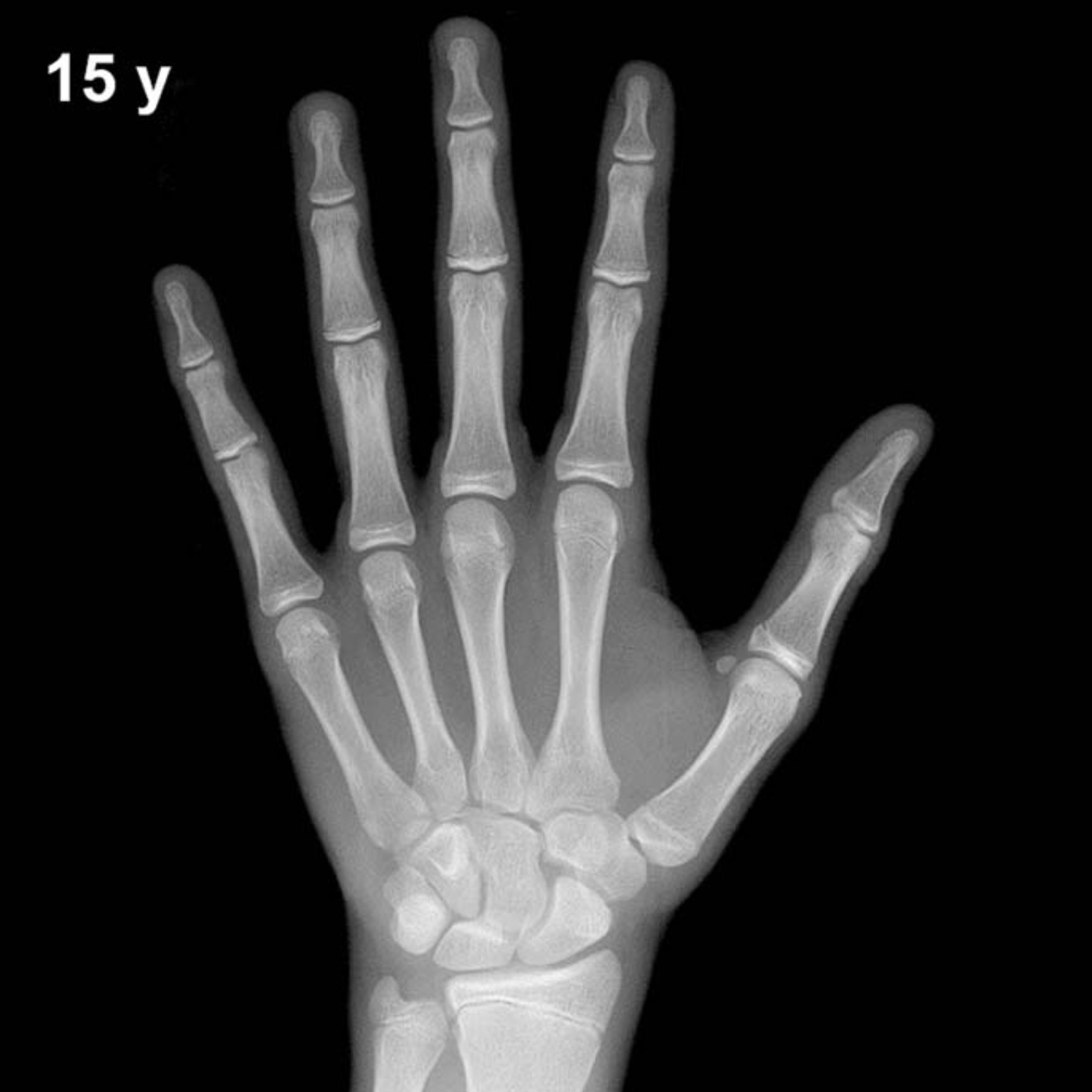 Reference hand and wrist X-ray: boys aged 15 years (Greulich-Pyle).