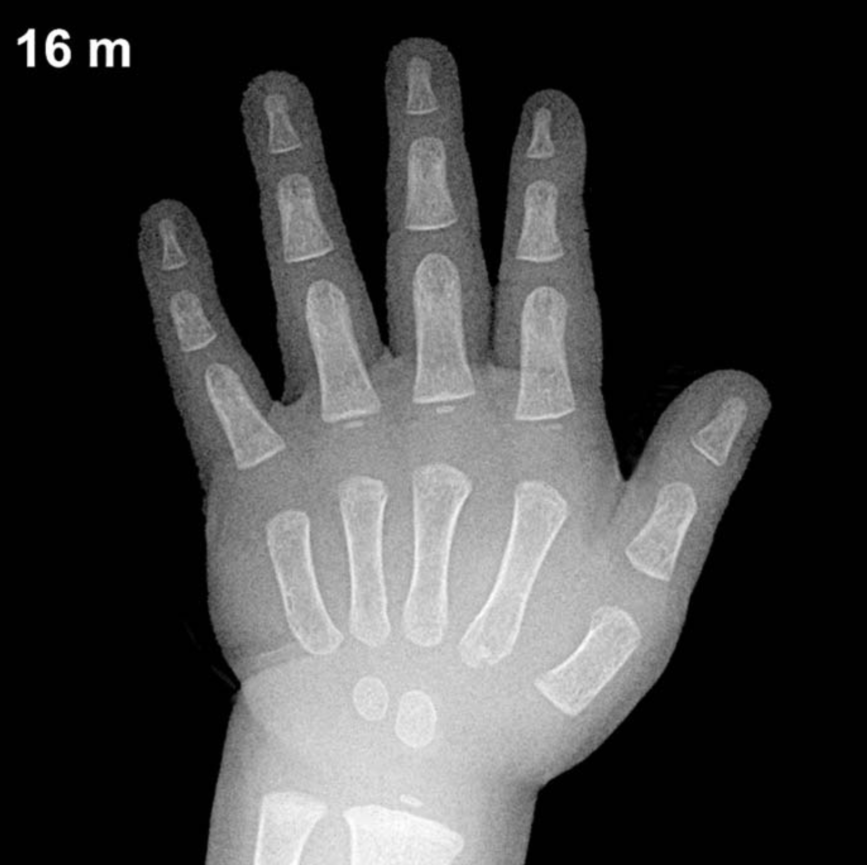Bone age hand X-ray, boys 16 months