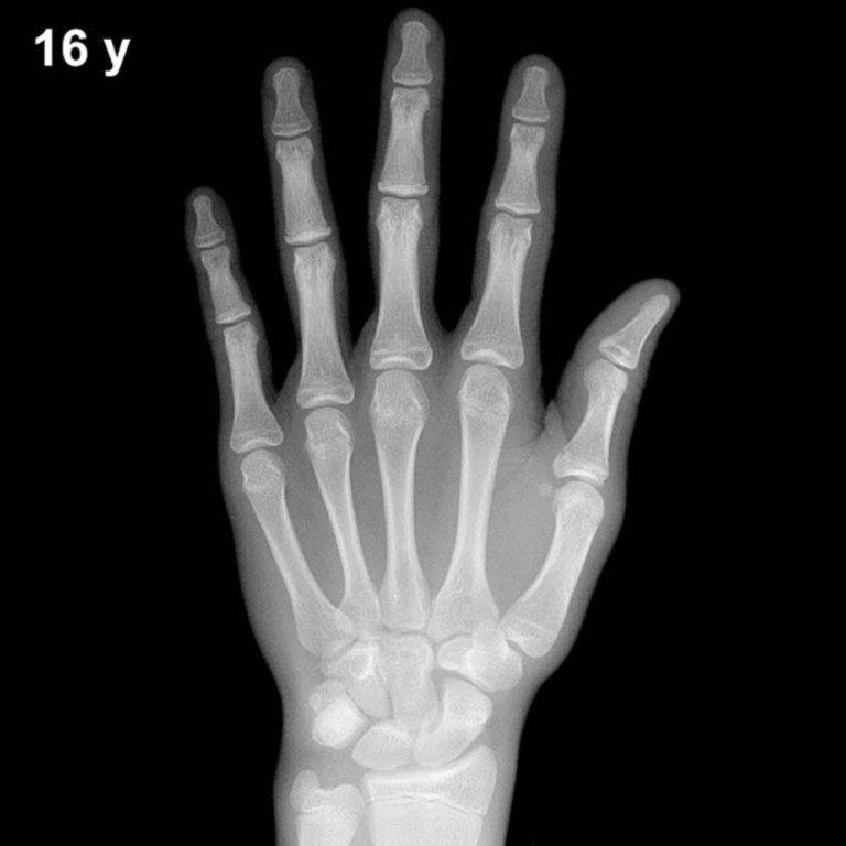 Bone age hand X-ray, boys 16 years