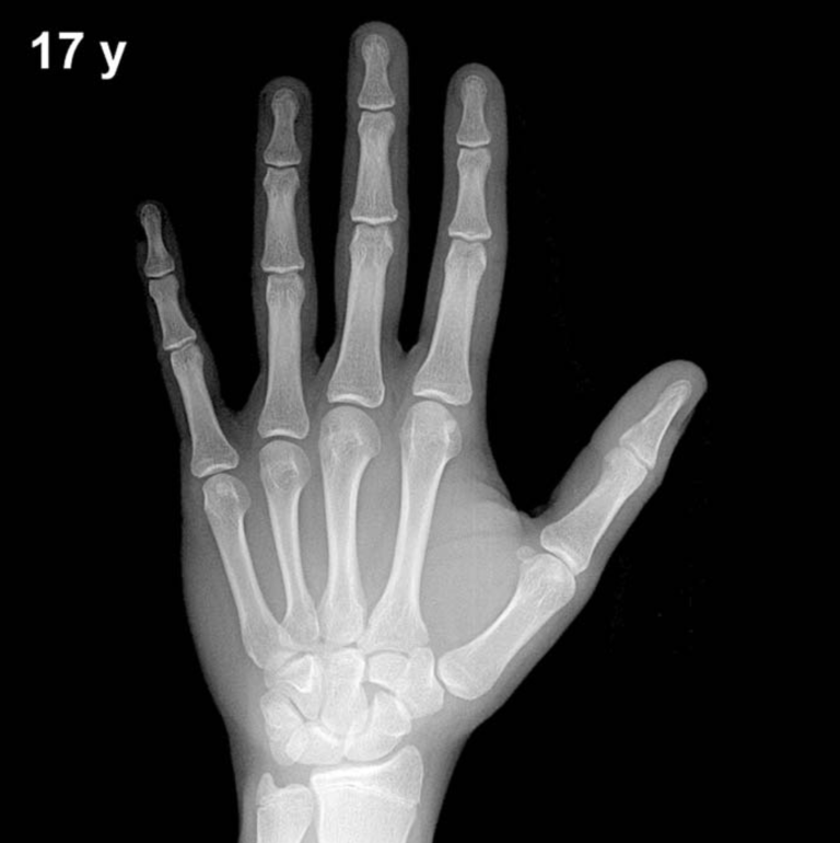 Bone age hand X-ray, boys 17 years