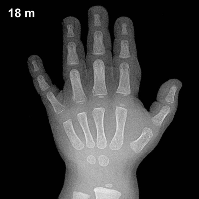 Bone age hand X-ray, boys 18 months