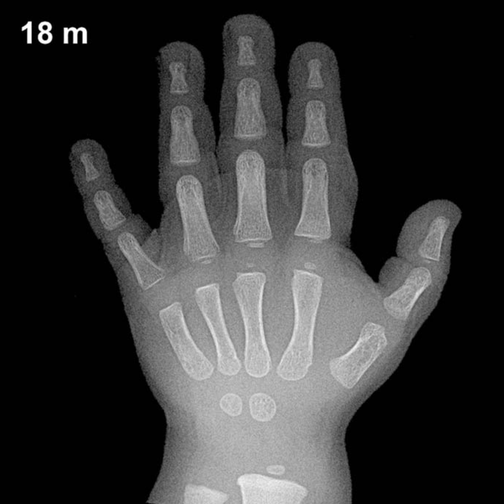 Bone age hand X-ray, boys 18 months