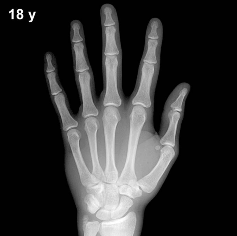 Bone age hand X-ray, boys 18 years