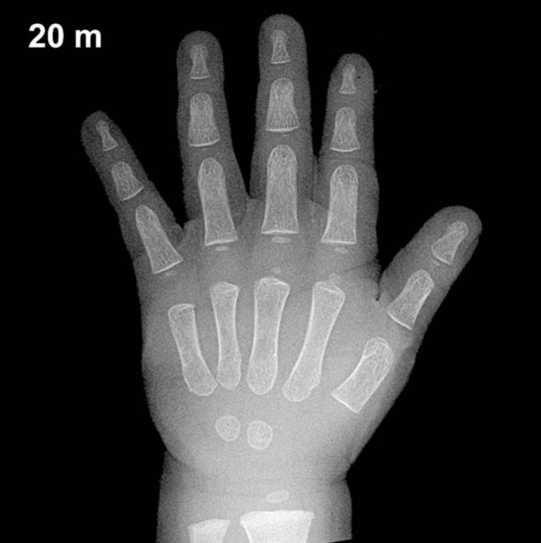 Bone age hand X-ray, boys 20 months