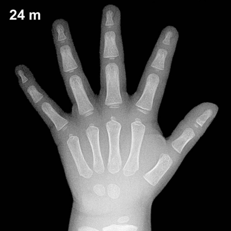 Bone age hand X-ray, boys 24 months