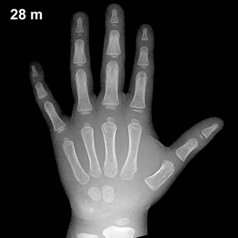Bone age hand X-ray, boys 28 months