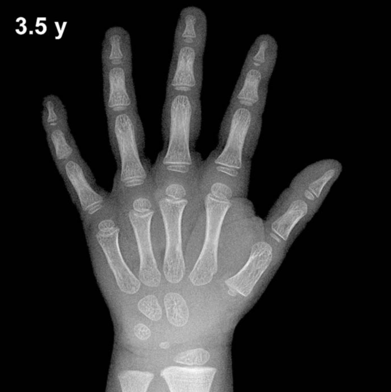 Bone age hand X-ray, boys 3.5 years