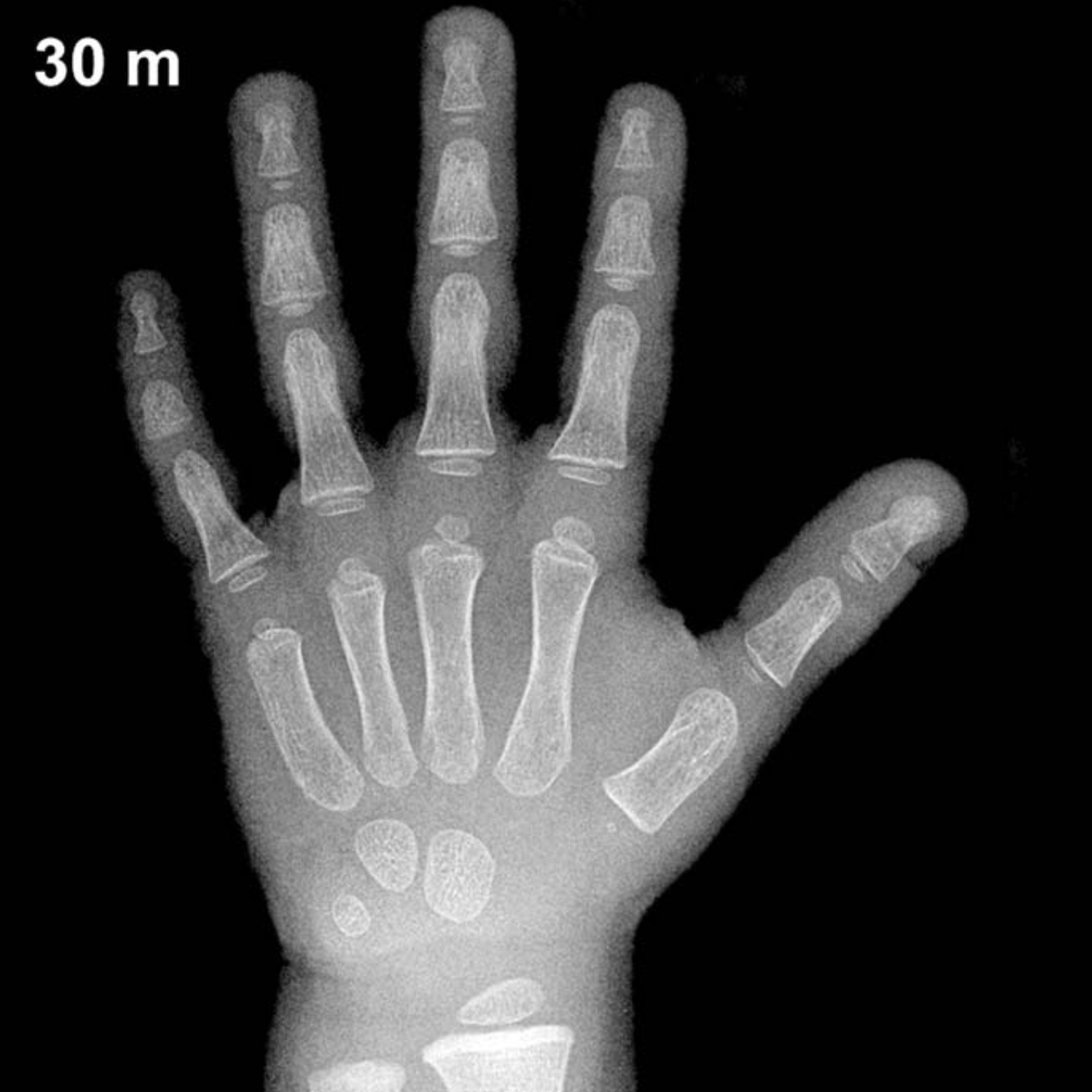 Bone age hand X-ray, boys 30 months