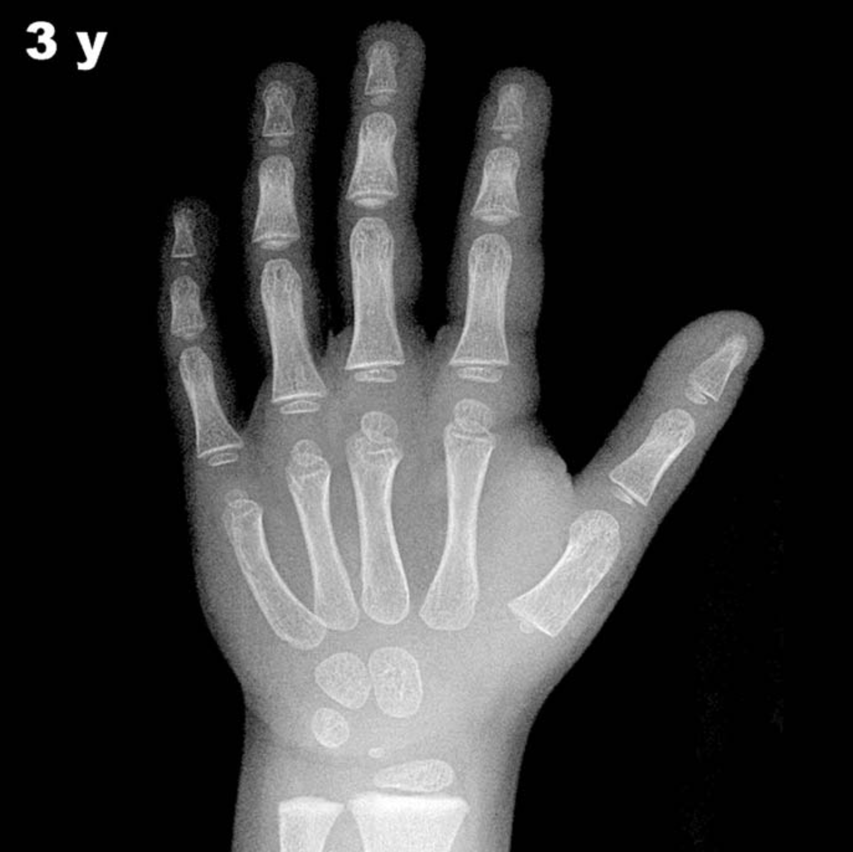Bone age hand X-ray, boys 3 years