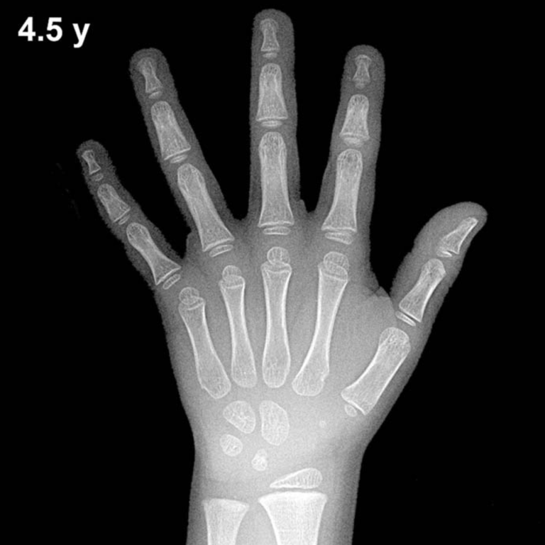 Bone age hand X-ray, boys 4.5 years