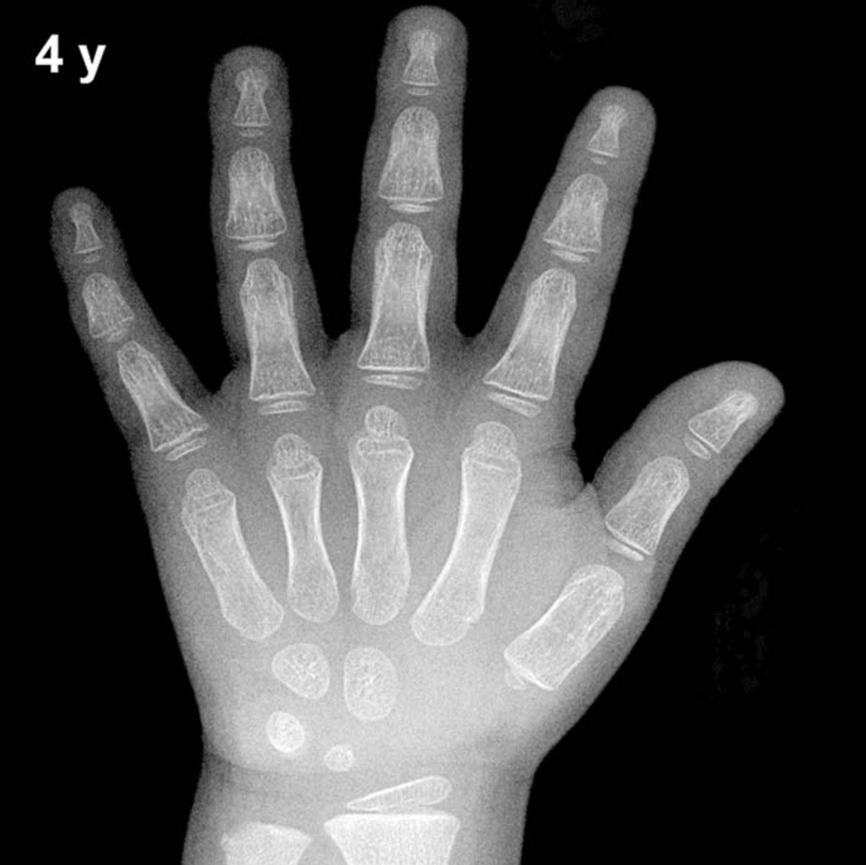 Bone age hand X-ray, boys 4 years