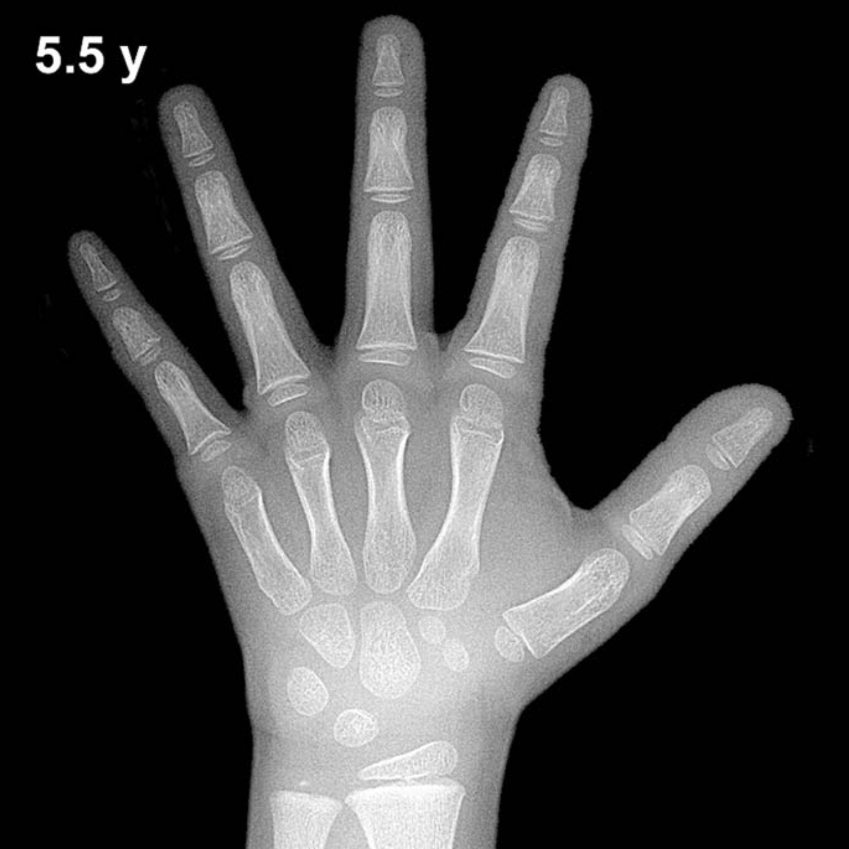 Bone age hand X-ray, boys 5.5 years