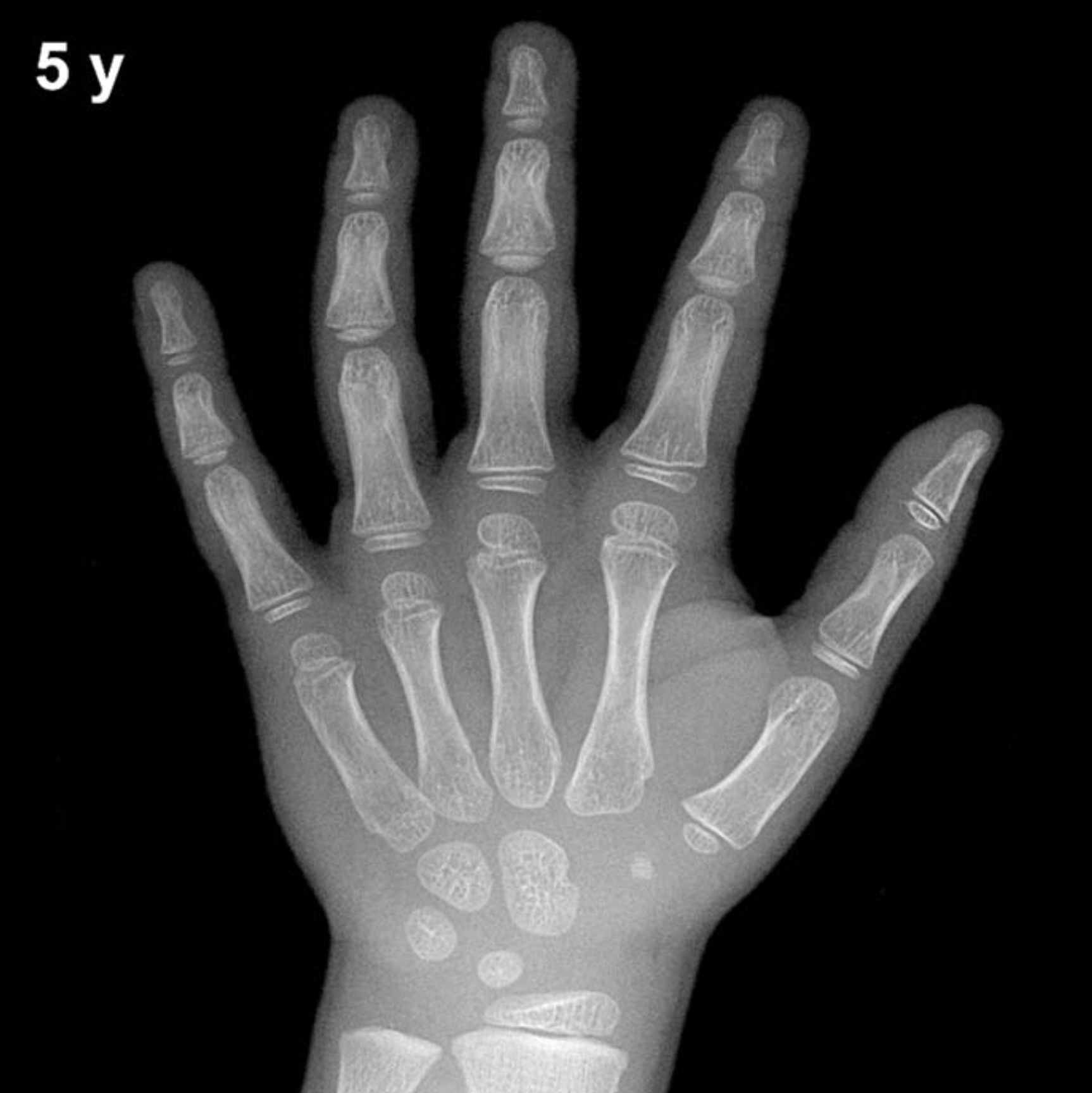 Bone age hand X-ray, boys 5 years