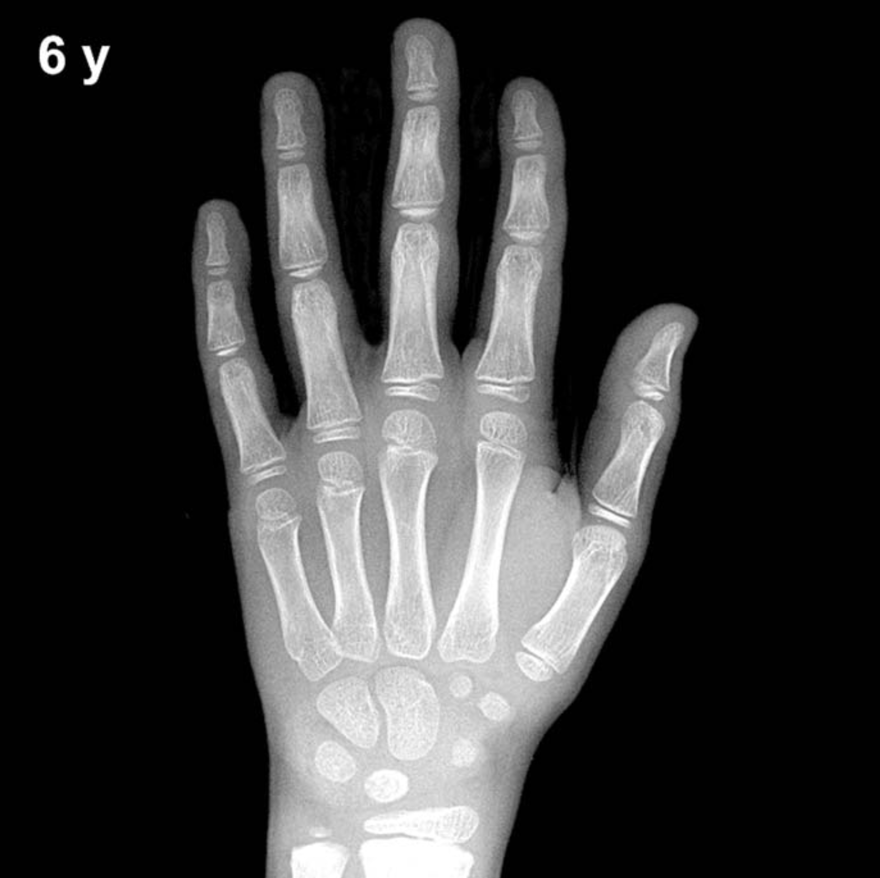 Bone age hand X-ray, boys 6 years