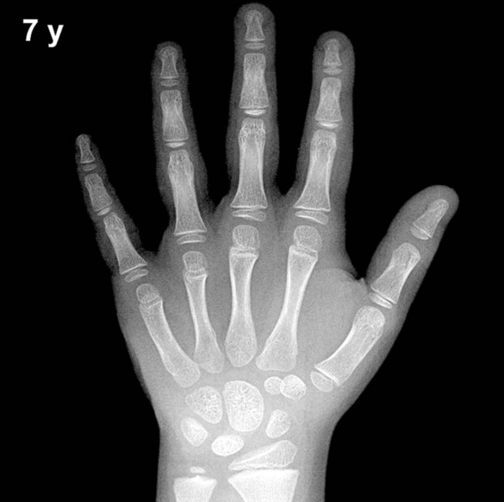 Bone age hand X-ray, boys 7 years