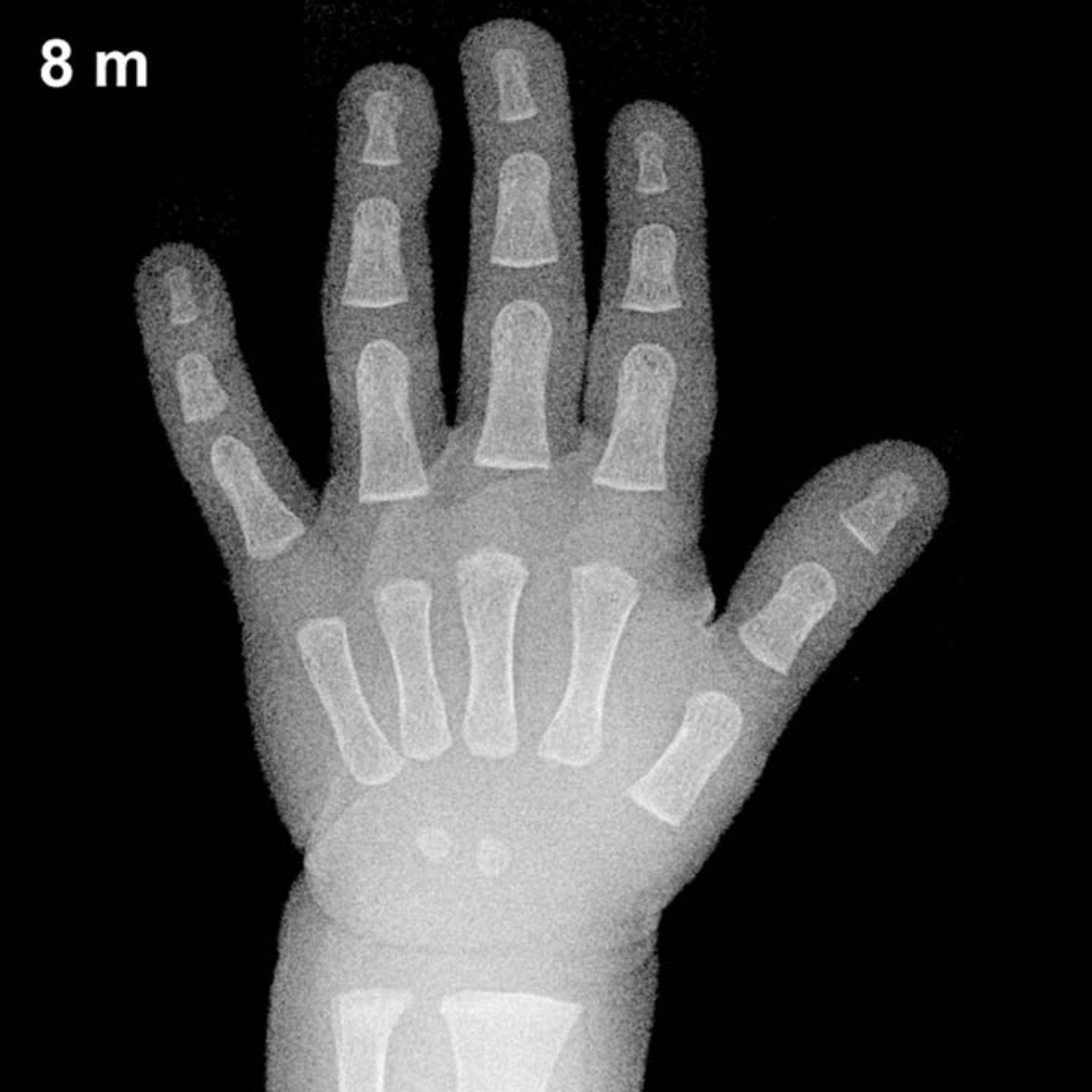 Bone age hand X-ray, boys 8 months