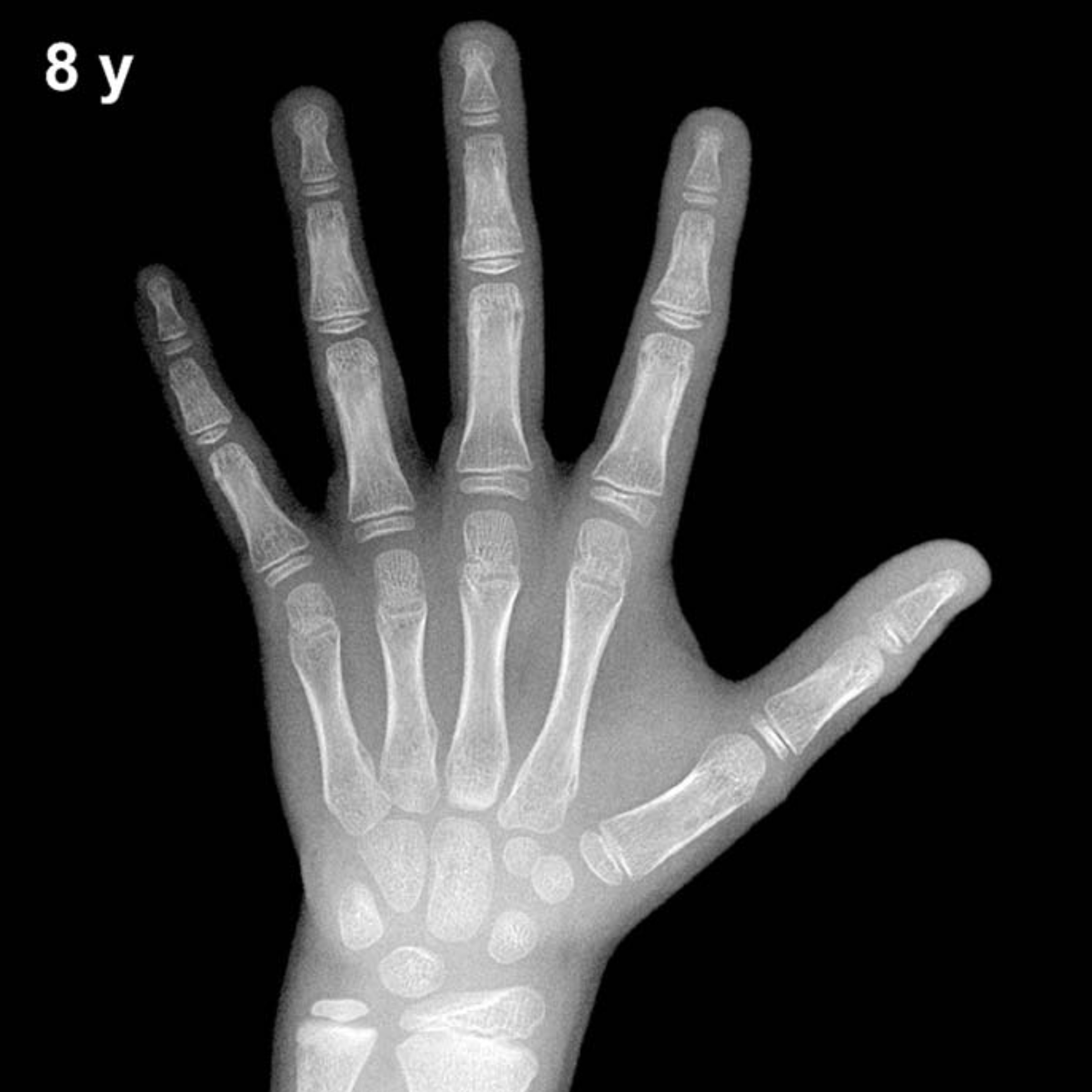Reference hand and wrist X-ray: boys aged 8 years (Greulich-Pyle).