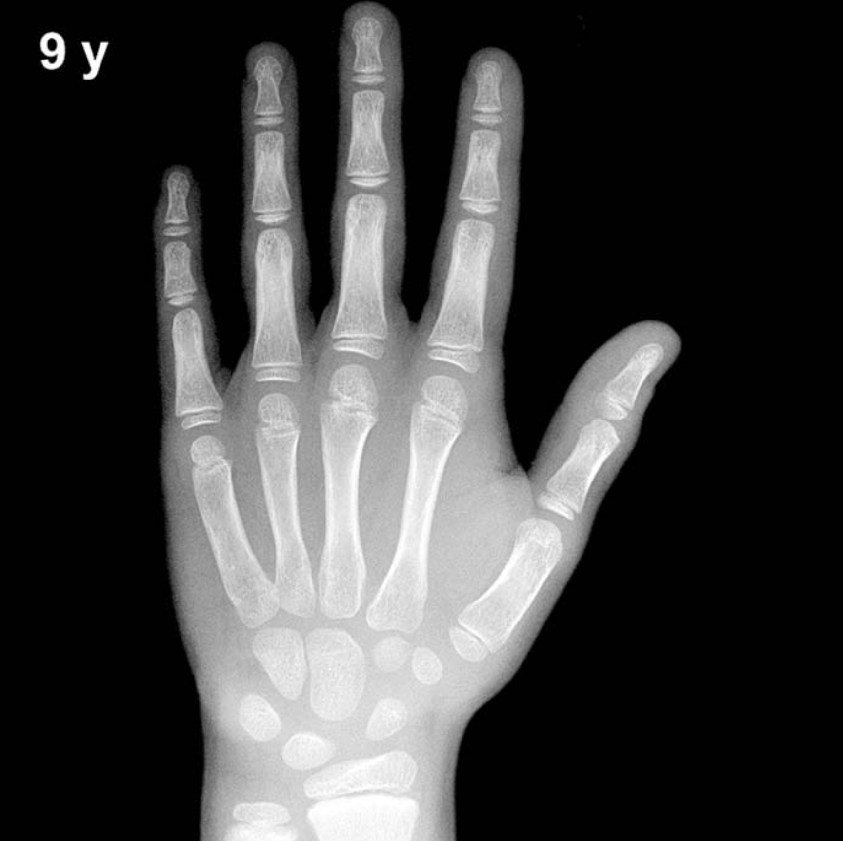 Reference hand and wrist X-ray: boys aged 9 years (Greulich-Pyle).