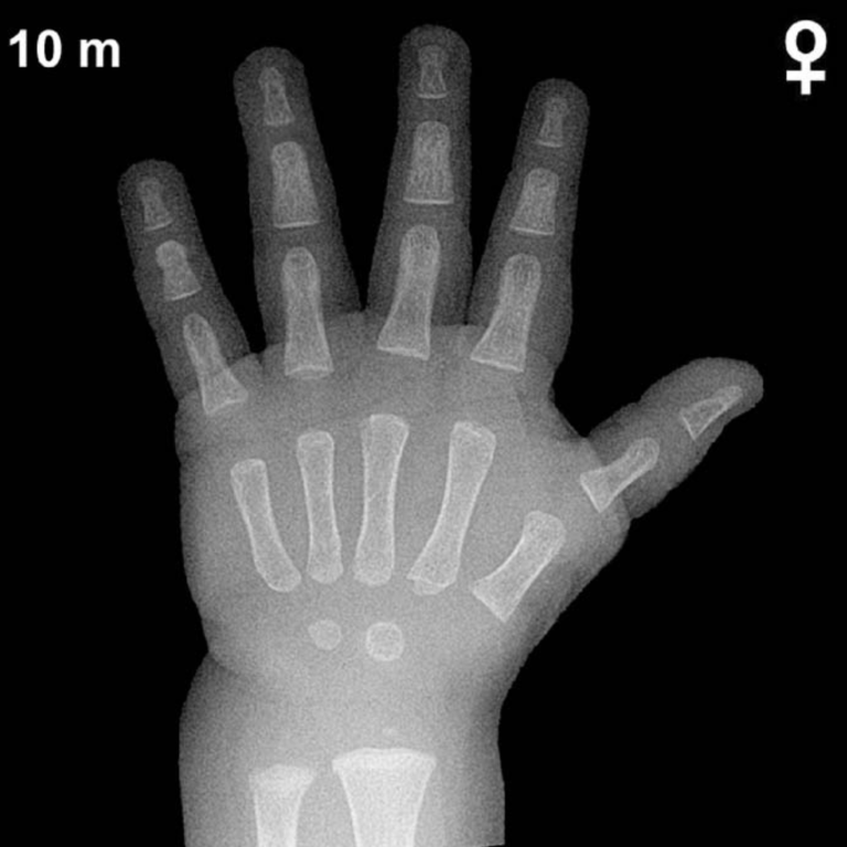 Bone age hand X-ray, girls 10 months