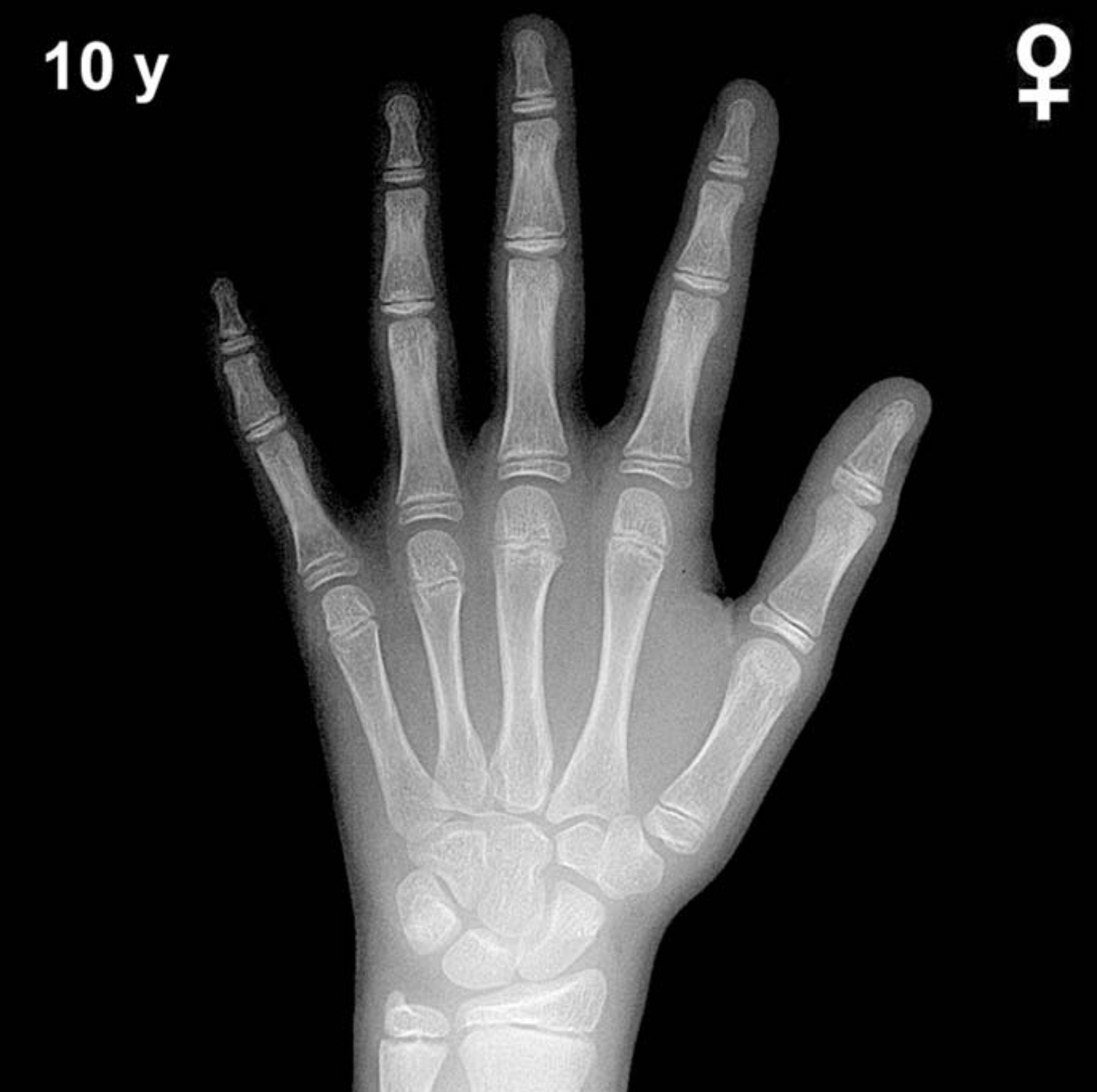 Bone age hand X-ray, girls 10 years