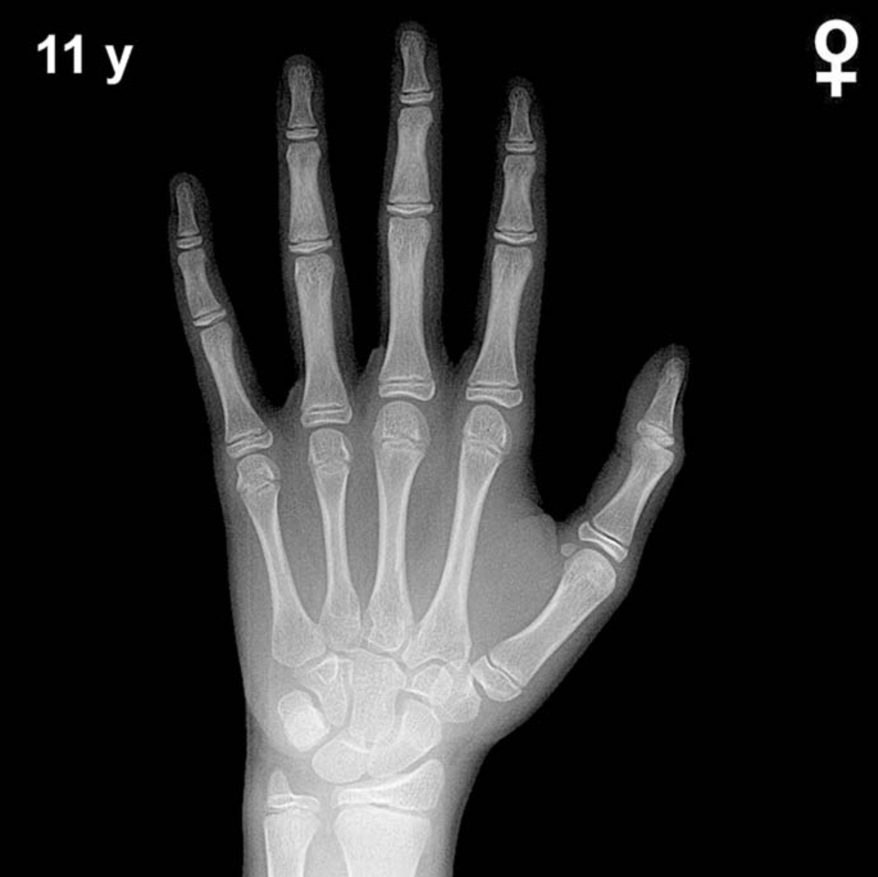 Reference hand and wrist X-ray: girls aged 11 years (Greulich-Pyle).