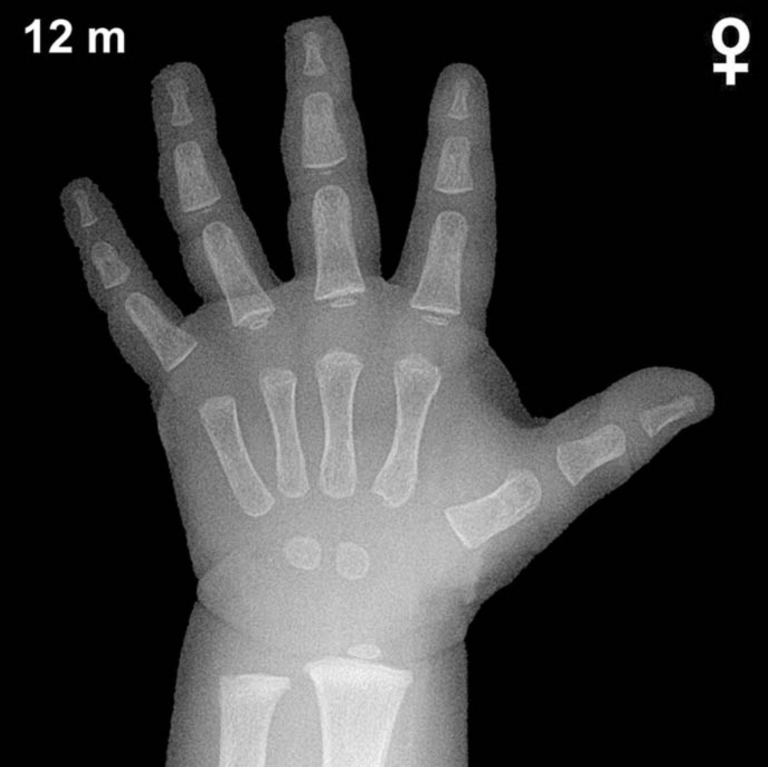Bone age hand X-ray, girls 12 months