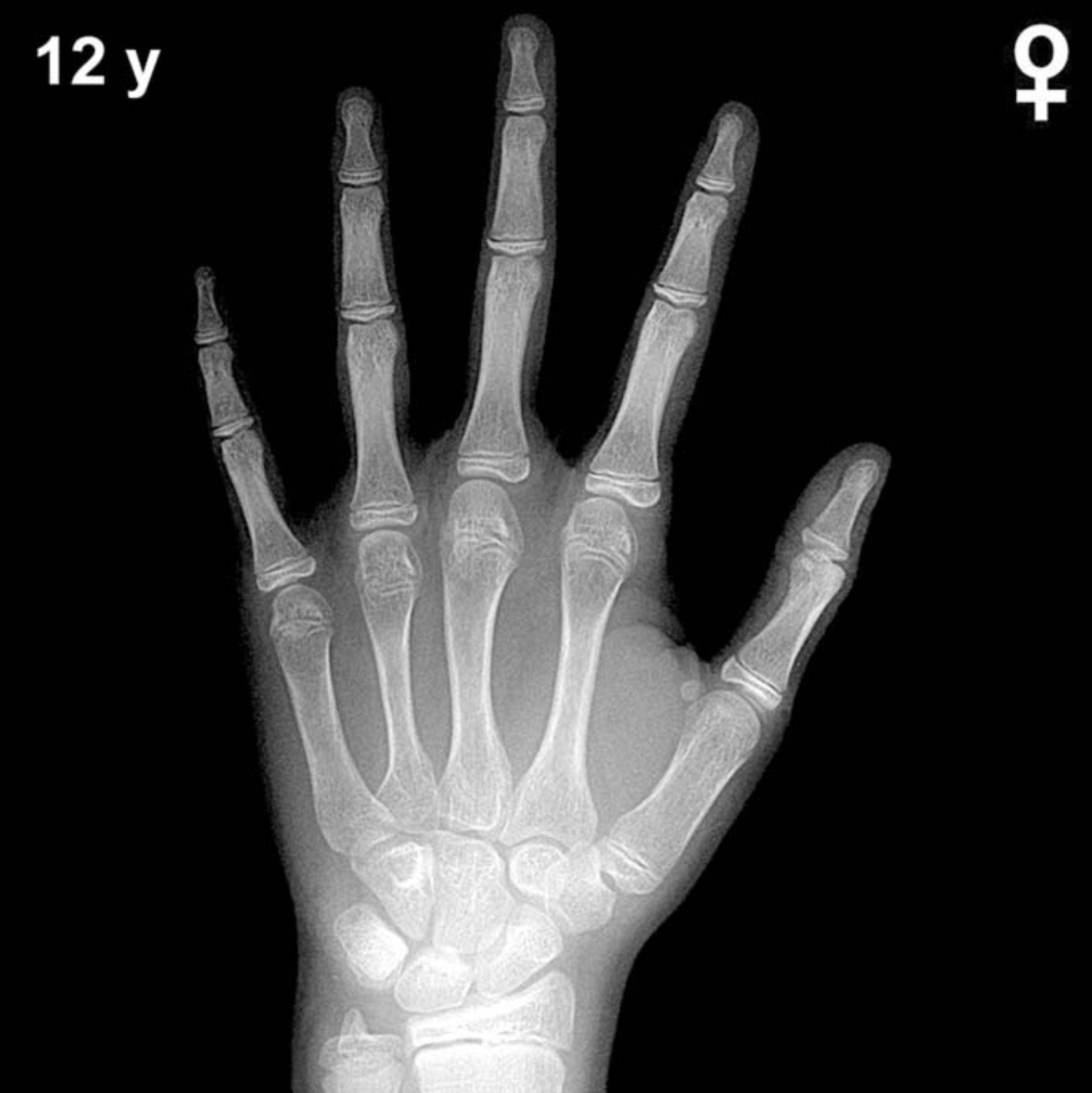 Reference hand and wrist X-ray: girls aged 12 years (Greulich-Pyle).