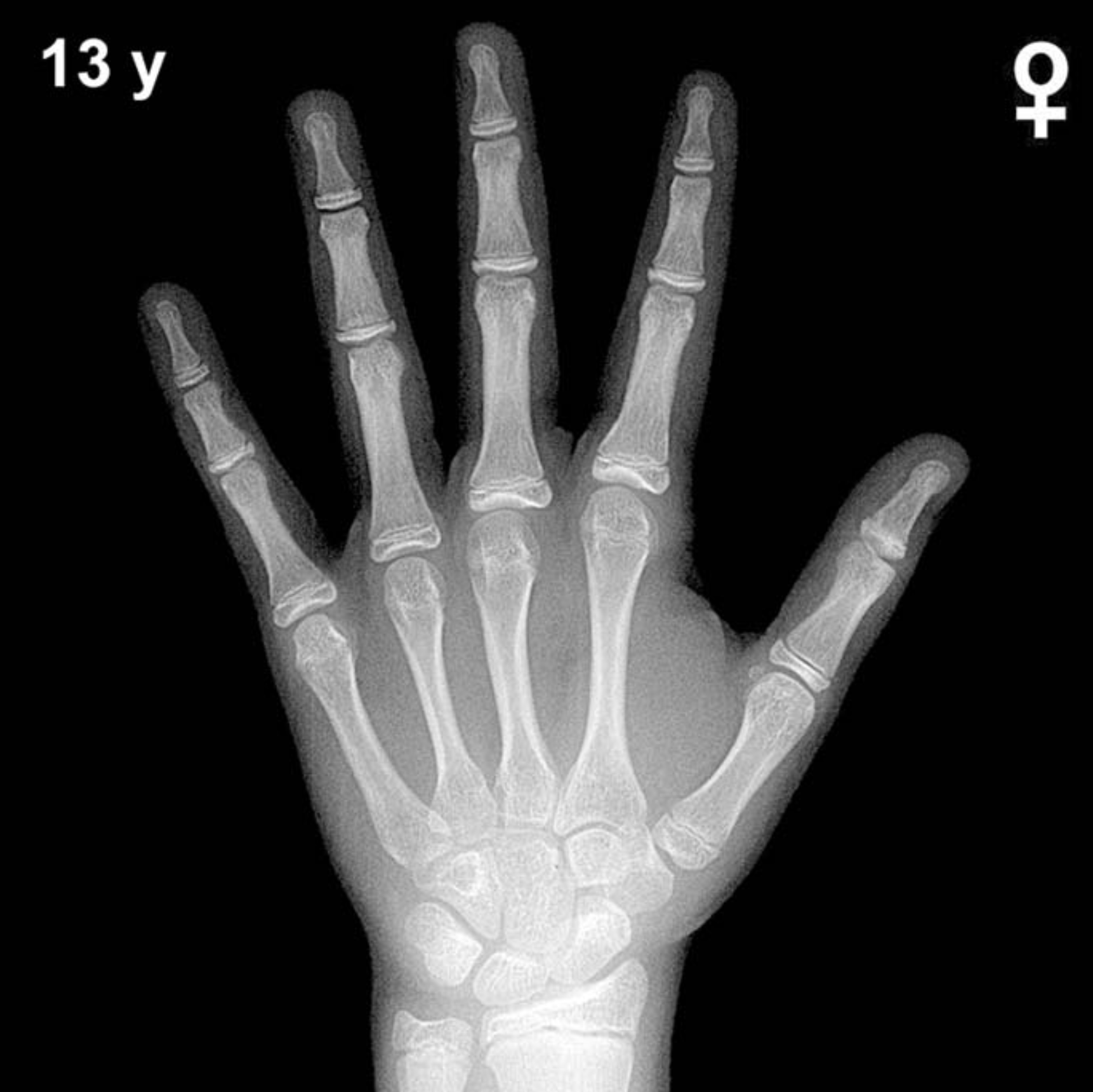 Bone age hand X-ray, girls 13 years
