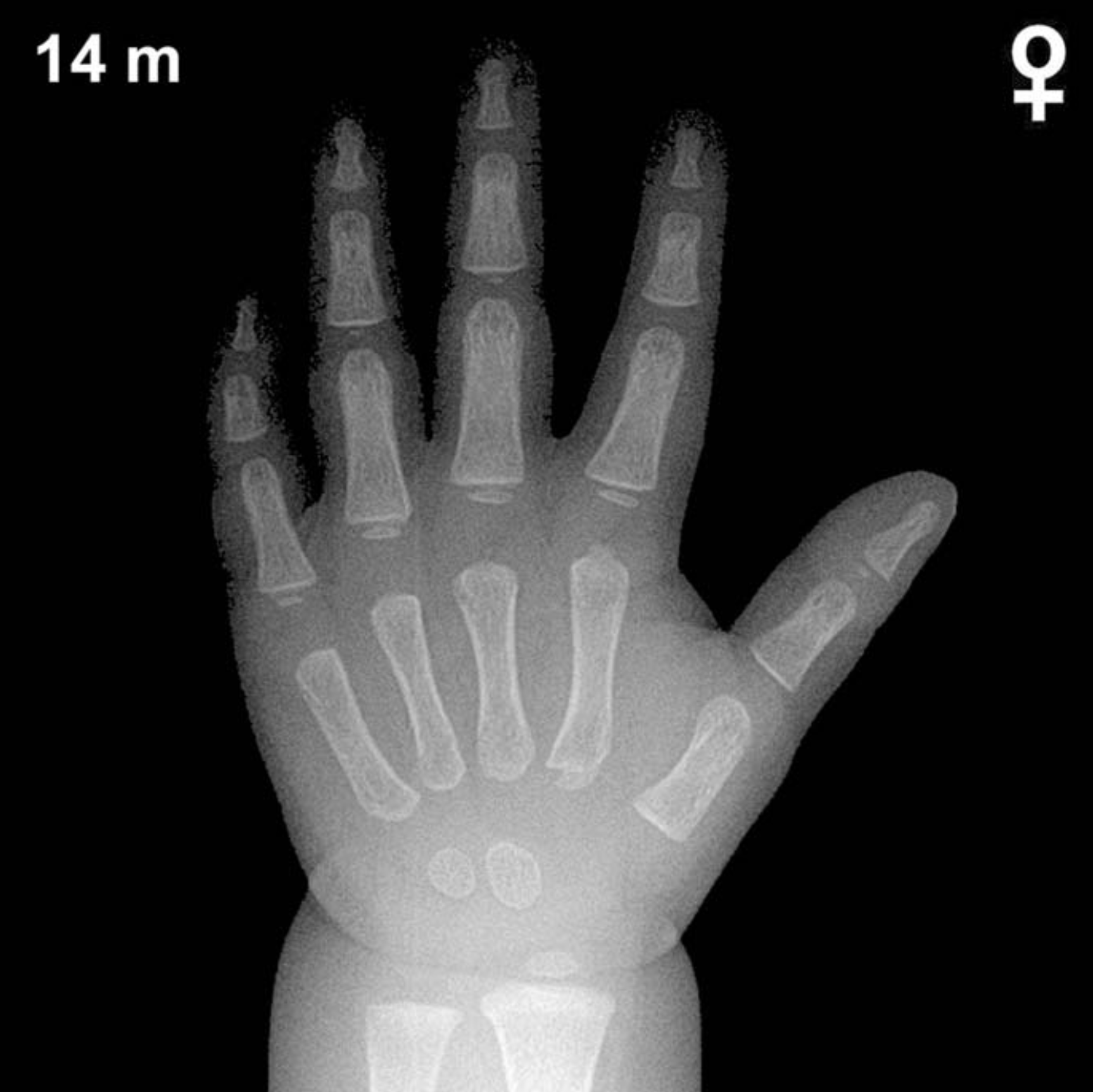 Reference hand and wrist X-ray: girls aged 14 months (Greulich-Pyle).