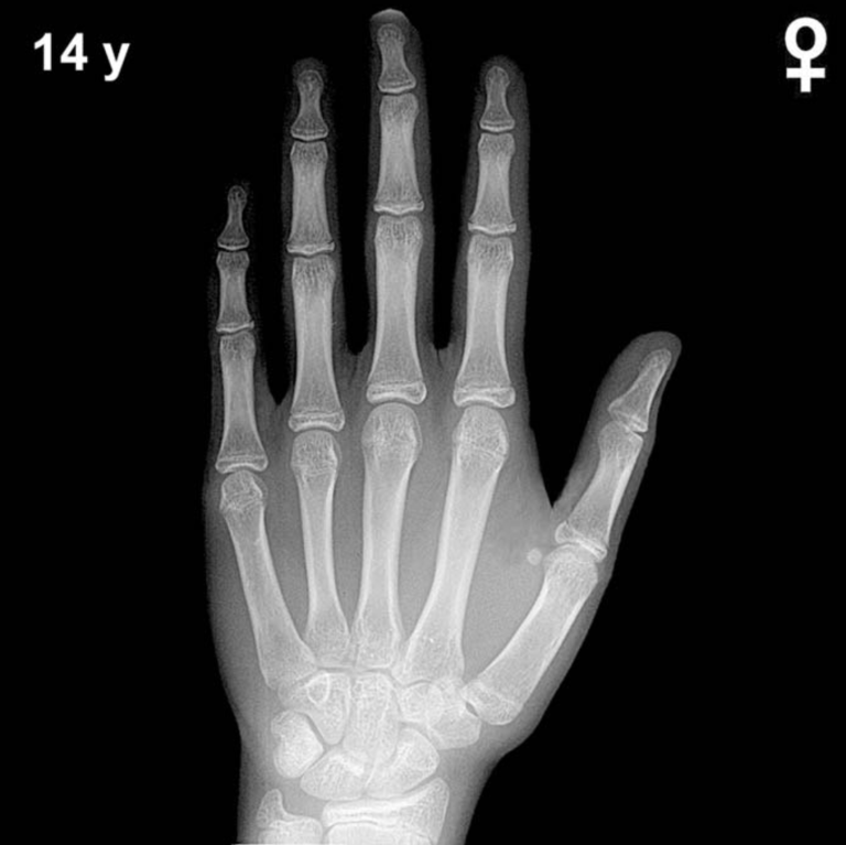 Bone age hand X-ray, girls 14 years