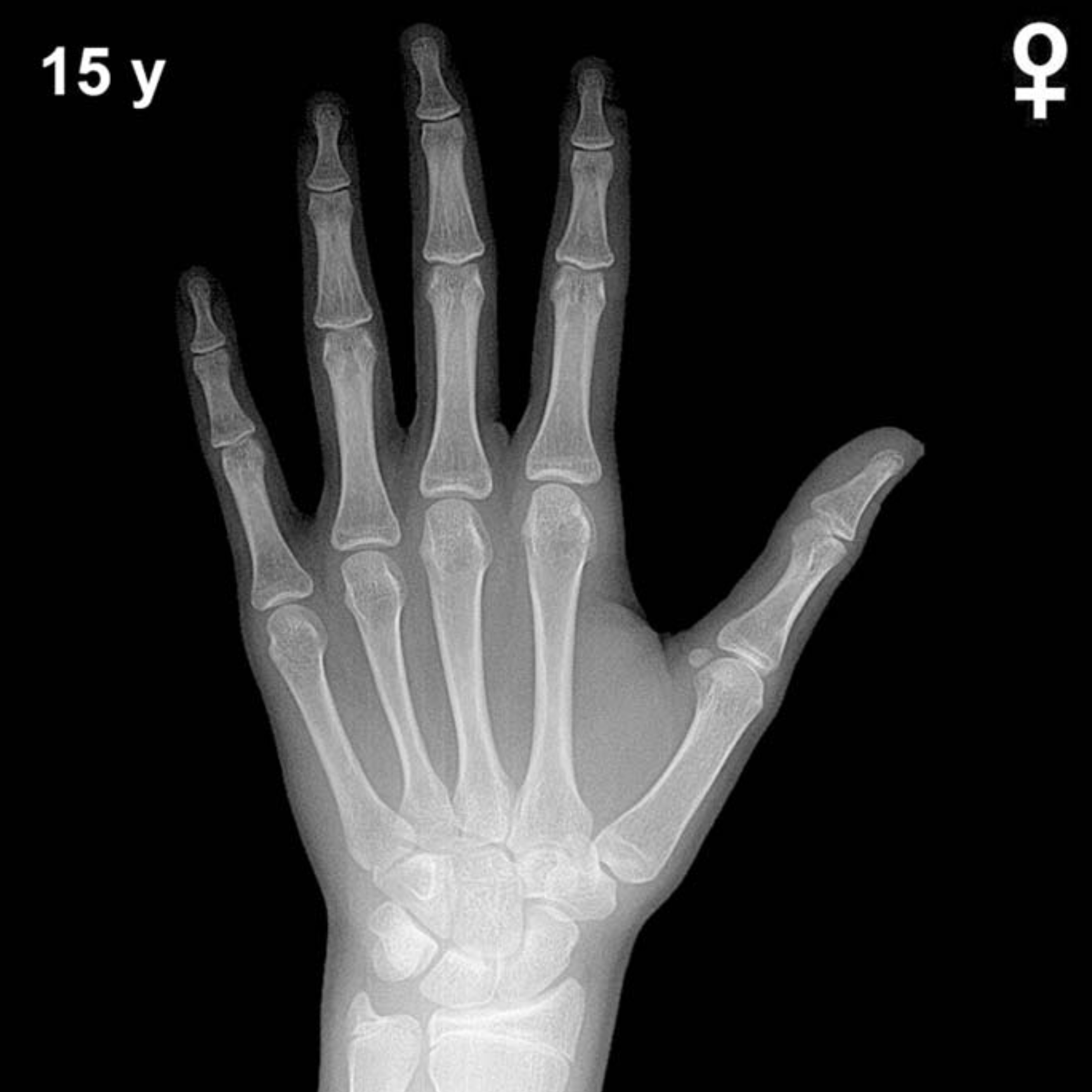 Bone age hand X-ray, girls 15 years