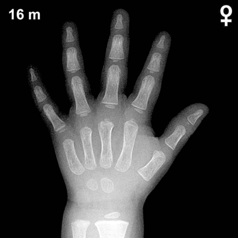 Bone age hand X-ray, girls 16 months