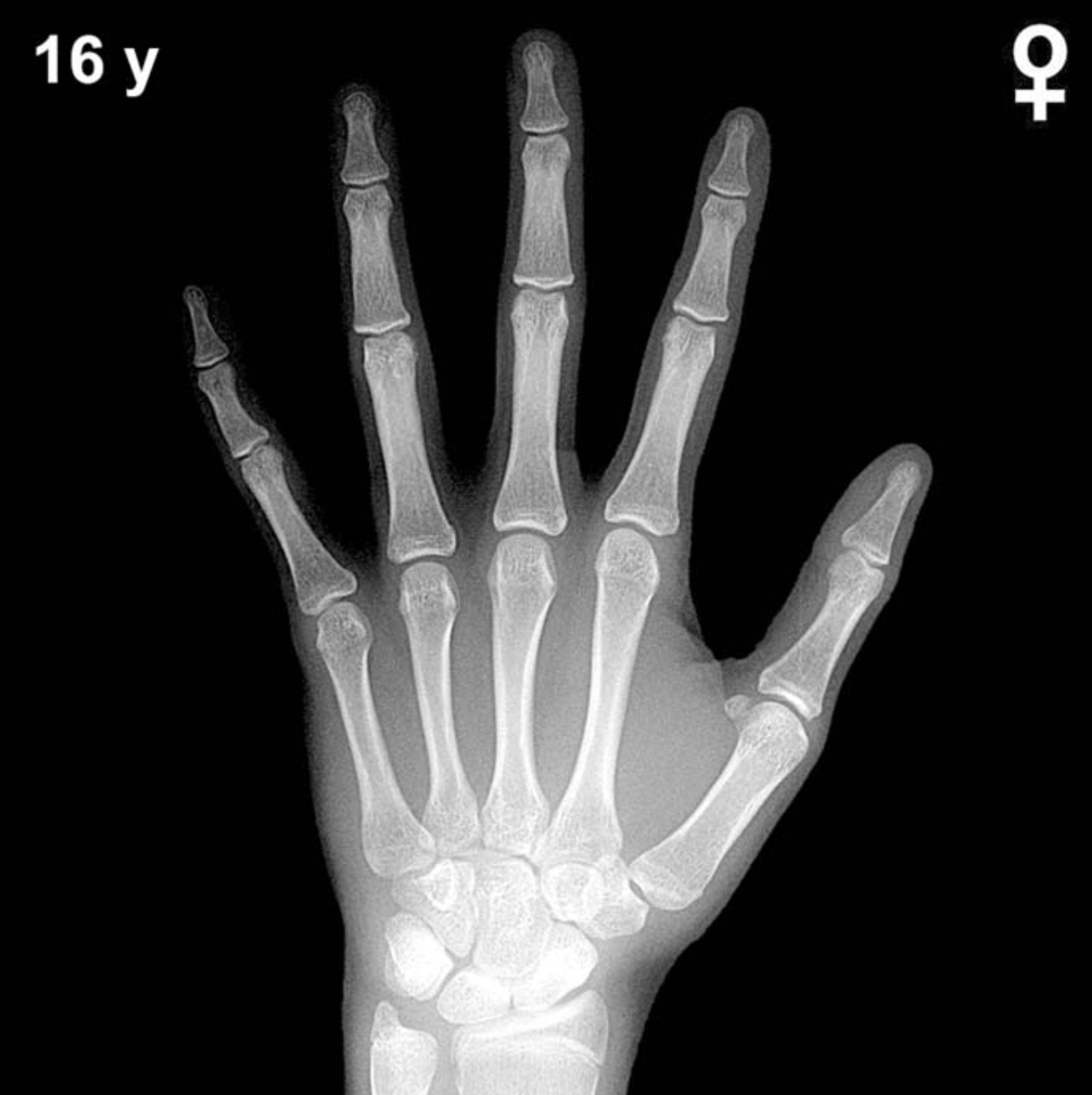 Reference hand and wrist X-ray: girls aged 16 years (Greulich-Pyle).