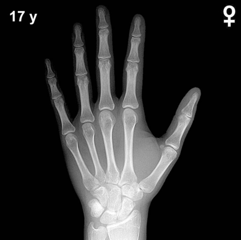 Bone age hand X-ray, girls 17 years
