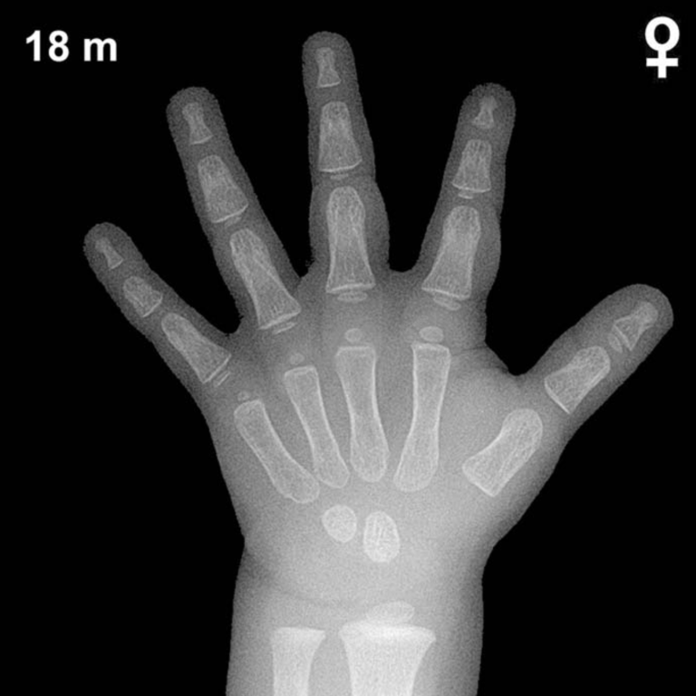 Bone age hand X-ray, girls 18 months
