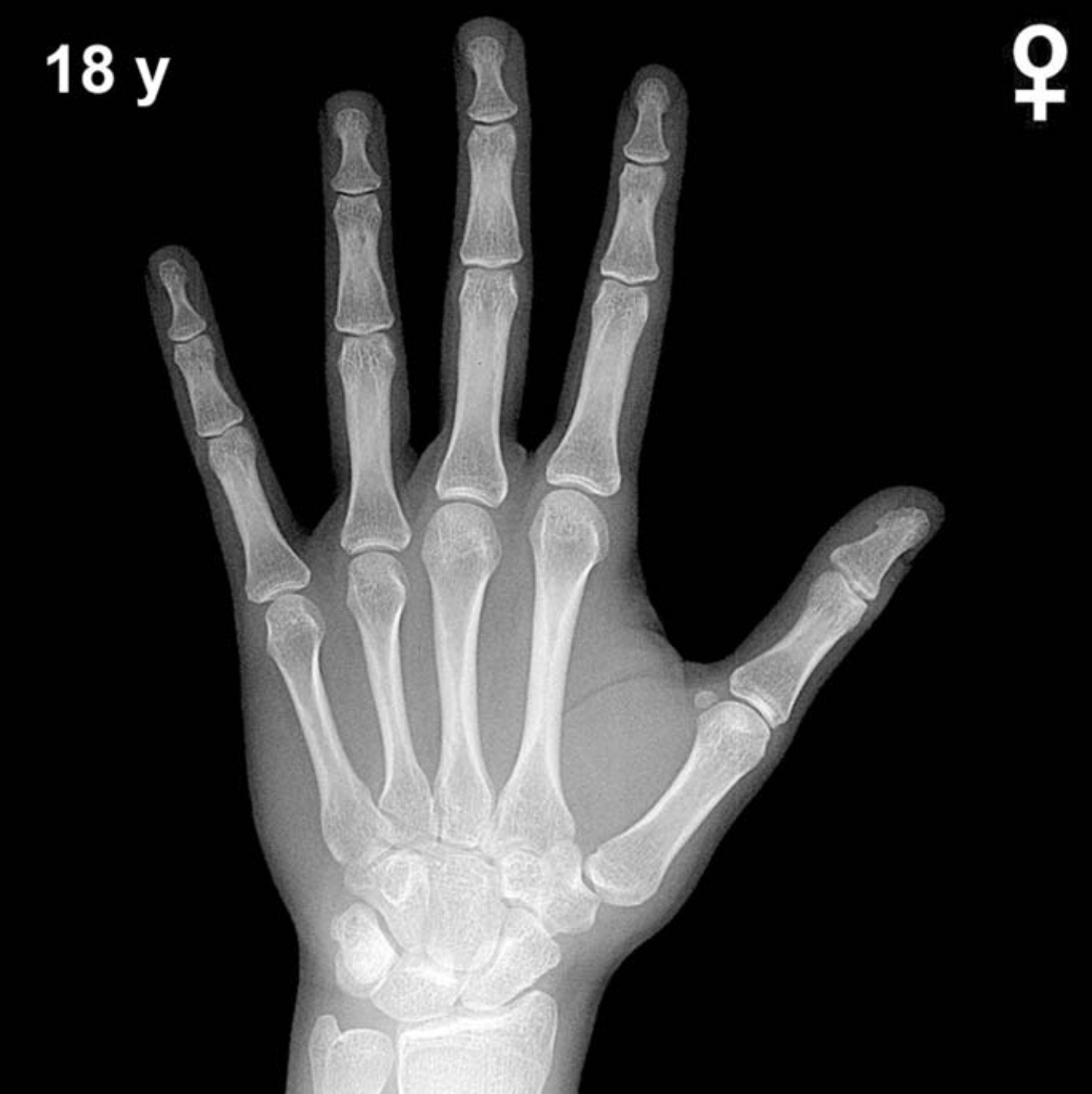 Reference hand and wrist X-ray: girls aged 18 years (Greulich-Pyle).