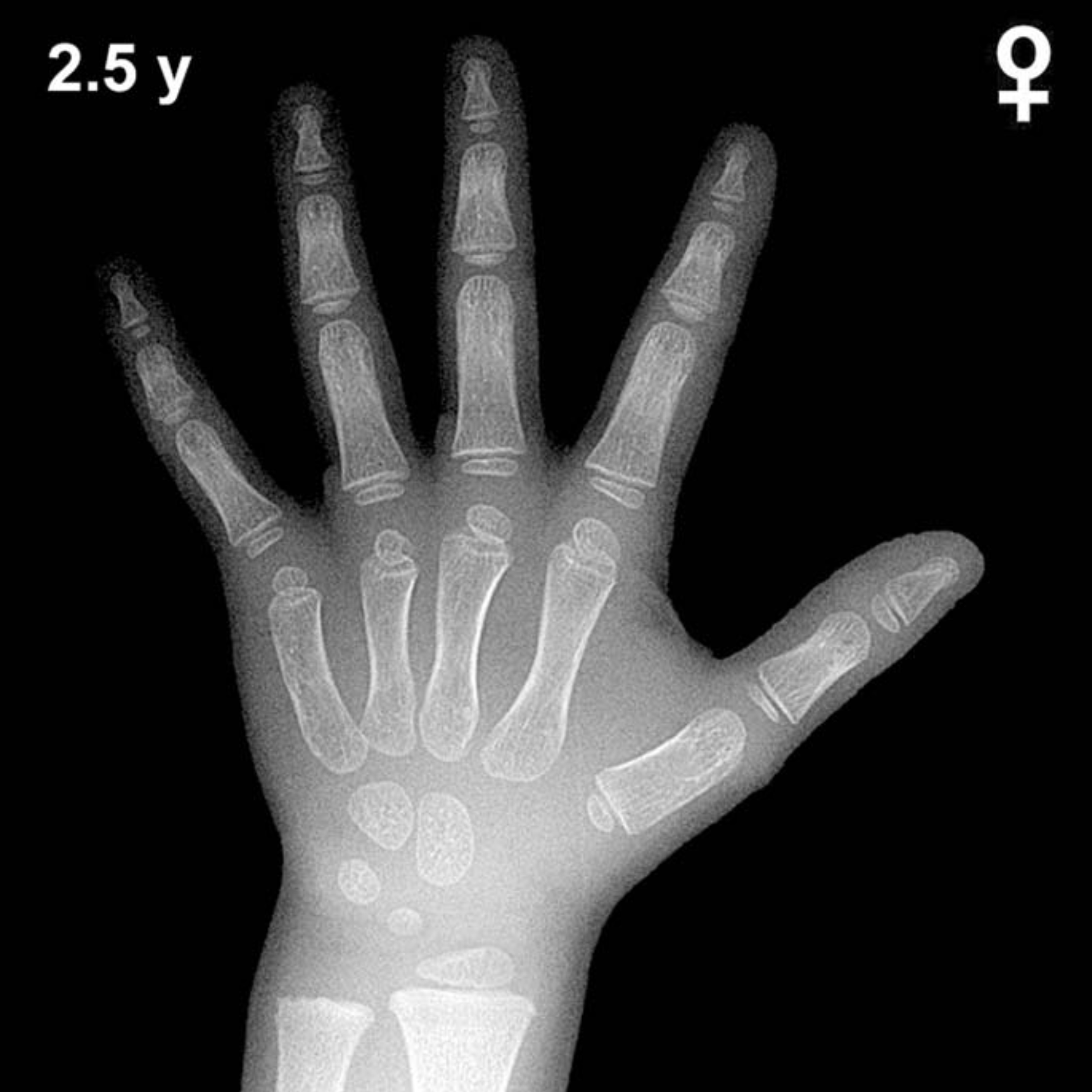 Bone age hand X-ray, girls 2.5 years
