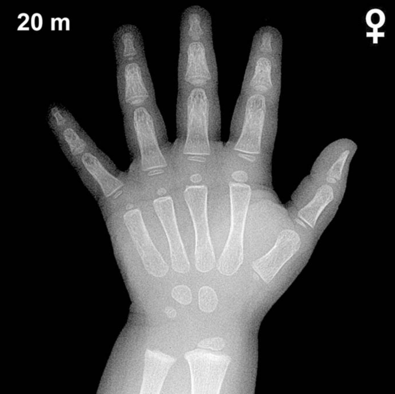 Bone age hand X-ray, girls 20 months