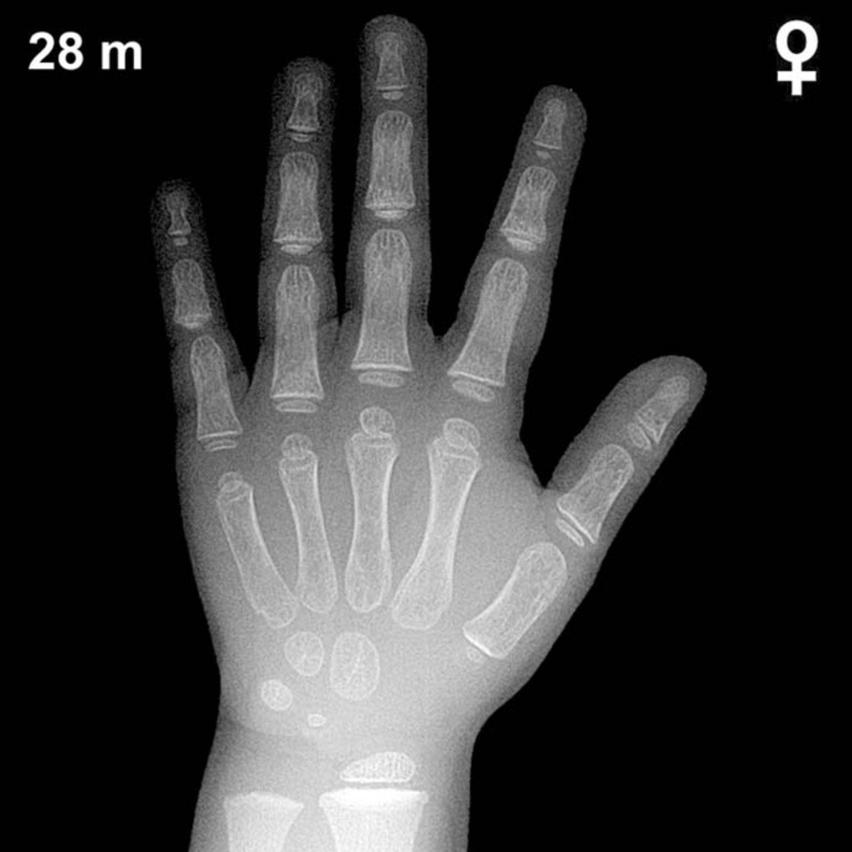 Reference hand and wrist X-ray: girls aged 28 months (Greulich-Pyle).