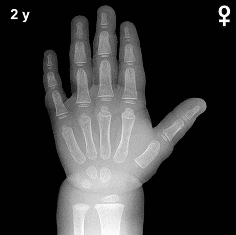 Bone age hand X-ray, girls 2 years