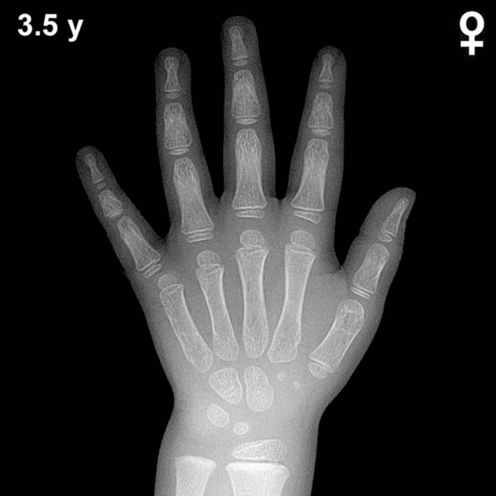Bone age hand X-ray, girls 3.5 years