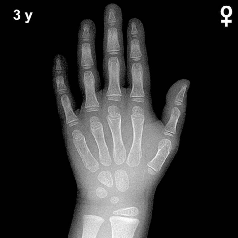 Bone age hand X-ray, girls 3 years